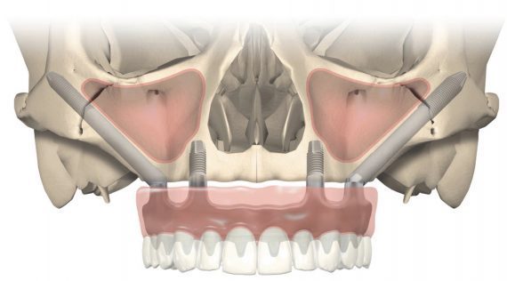 скуловые имплантаты NobelZygoma вместо костной пластики на верхней челюсти